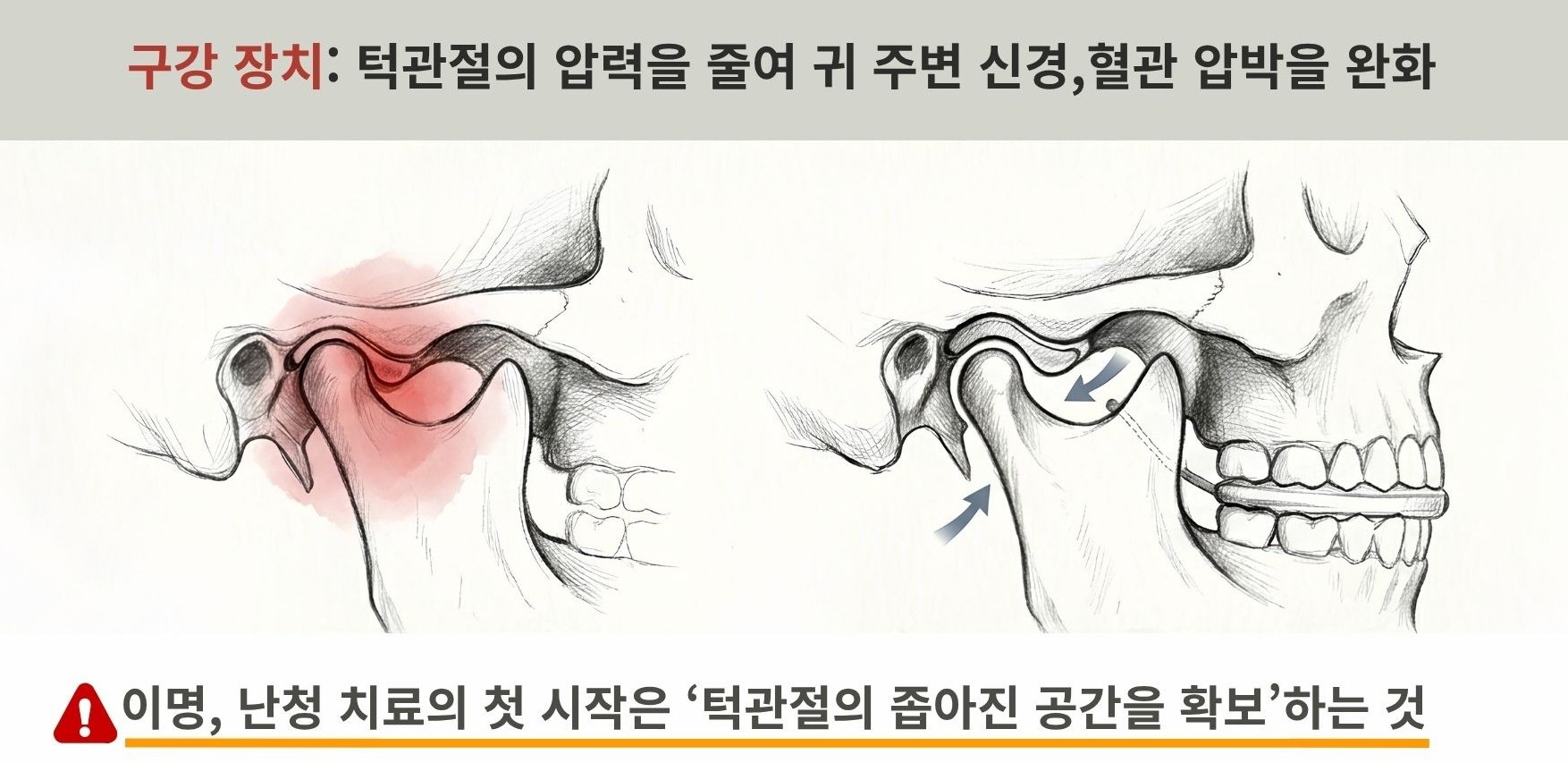 구강 장치로 턱관절에 눌린 압력을 줄여(Compressed→Decompressed) 귀 주변 신경·혈관 압박을 완화하는 원리 도식 — 이명·난청 치료의 시작은 턱관절의 좁아진 공간 확보