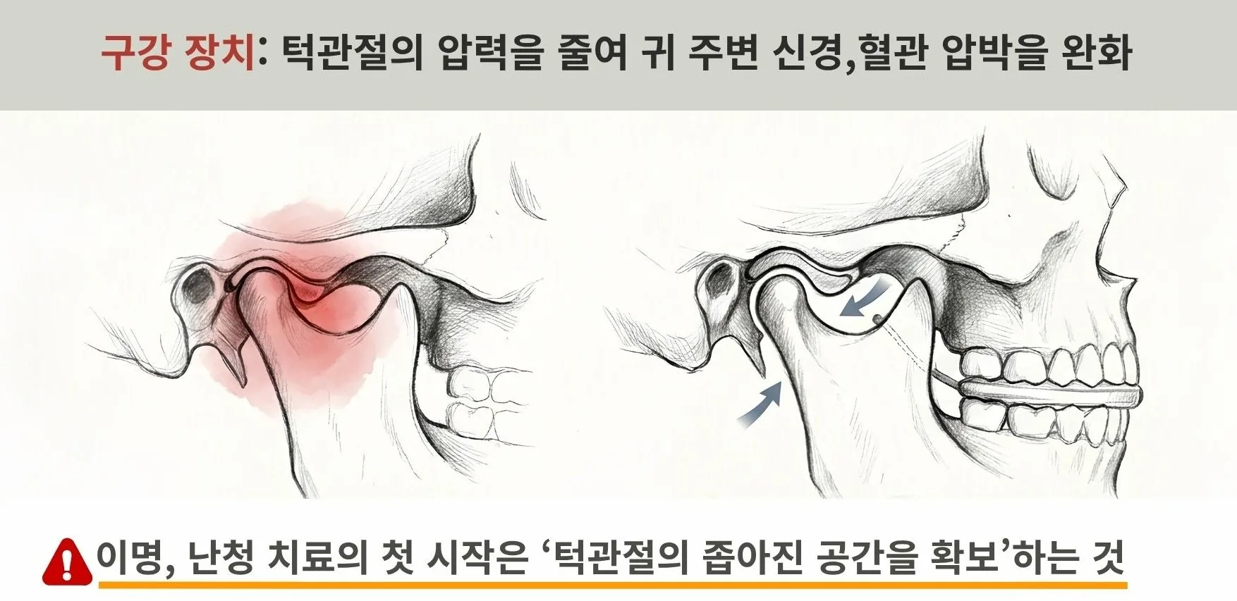 구강 장치로 턱관절에 눌린 압력을 줄여(Compressed→Decompressed) 귀 주변 신경·혈관 압박을 완화하는 원리 도식 — 이명·난청 치료의 시작은 턱관절의 좁아진 공간 확보