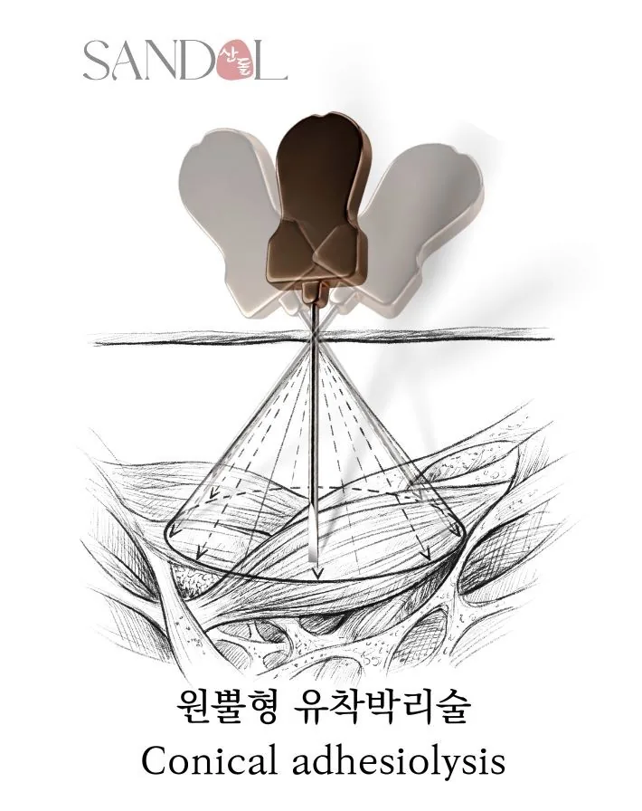 추형(錐形) 유착박리술 모식도 — 단일 진입점을 꼭짓점 삼아 원뿔 형태로 깊은 유착을 입체적으로 박리