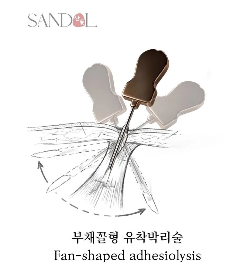 선형(扇形) 유착박리술 모식도 — 한 진입점에서 부채꼴로 넓은 유착면을 여러 각도로 박리