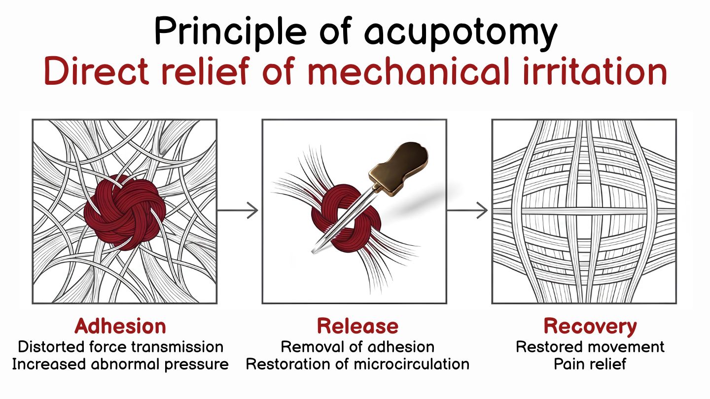 The role of acupotomy: directly resolving the mechanical stimulus — adhesion, release, recovery