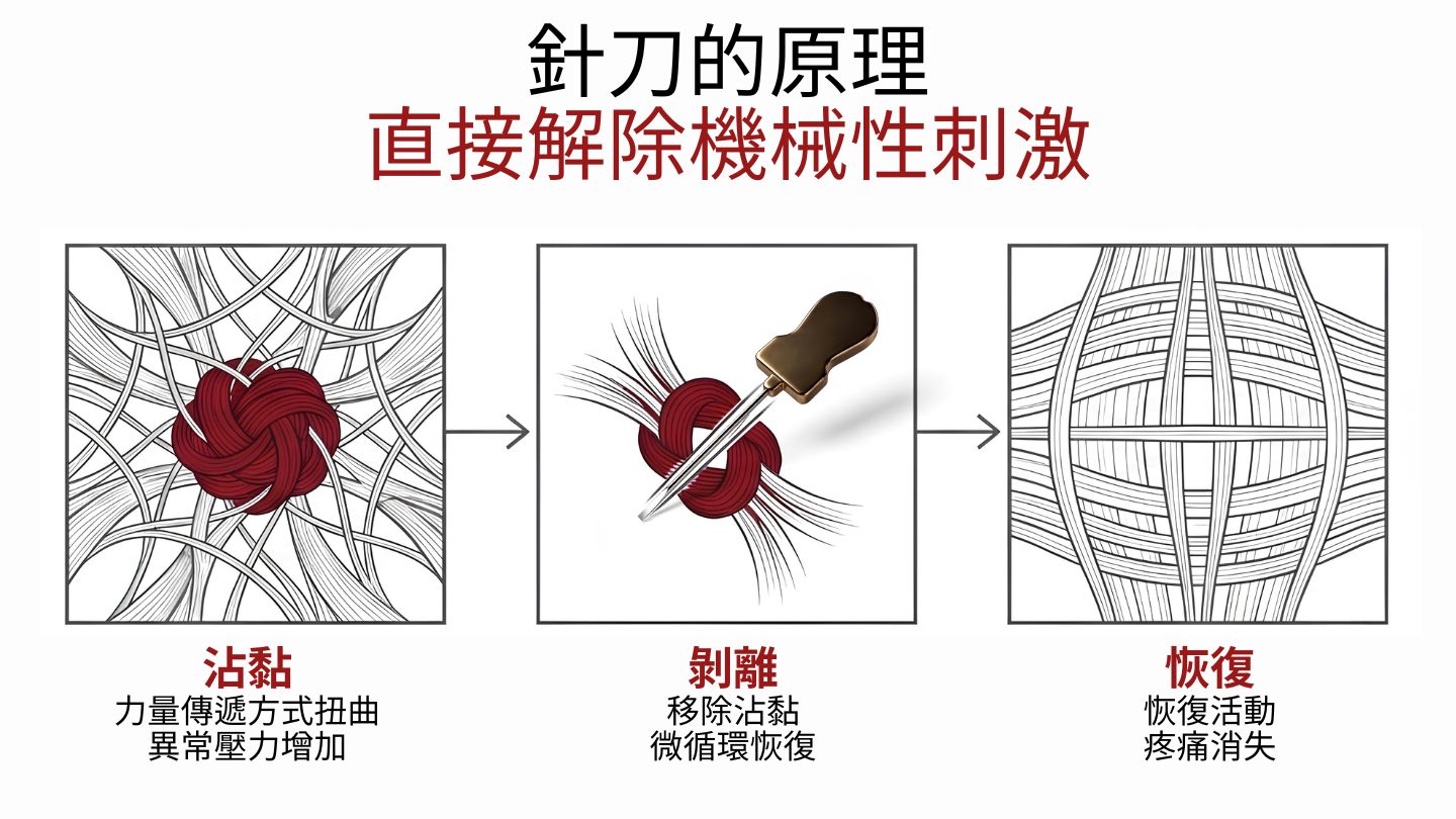 針刀的角色：直接解除機械性刺激 — 沾黏、剝離、恢復的三階段