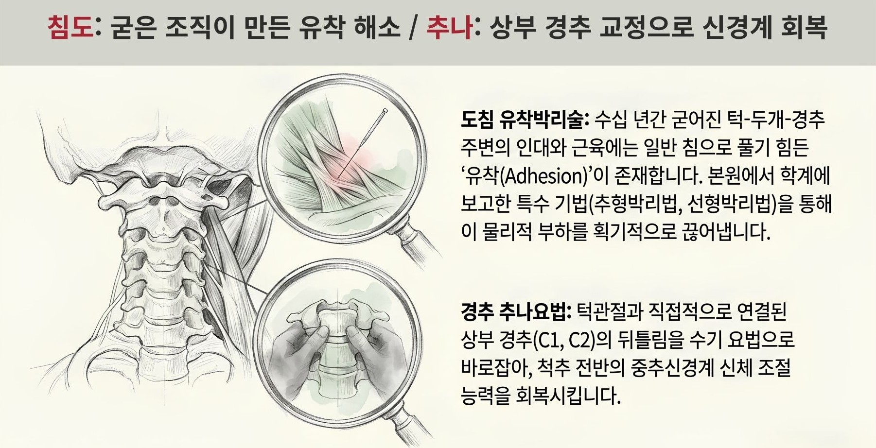 침도(도침)로 수십 년 굳은 턱–두개–경추 주변 유착(Adhesion)을 박리하고, 경추 추나요법으로 상부 경추(C1·C2) 뒤틀림을 바로잡아 신경계를 회복하는 원리 도식