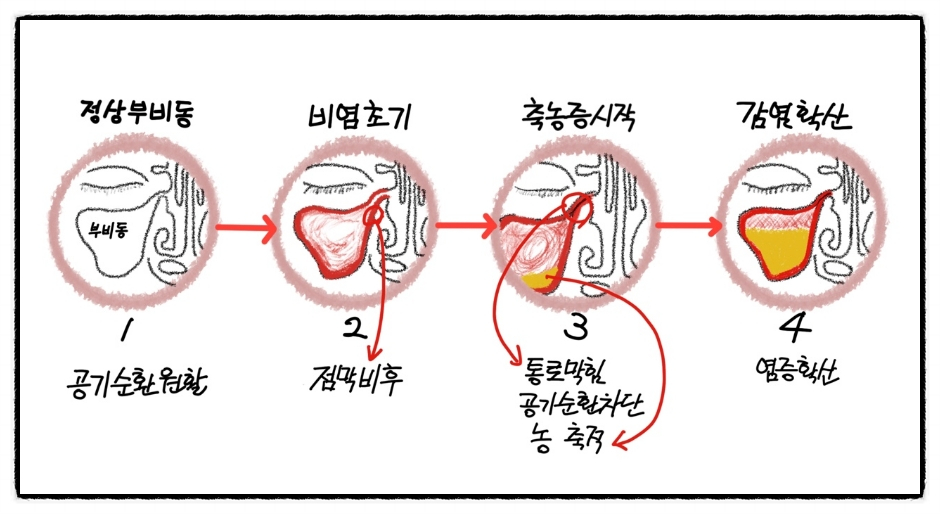 보존적으로 관리하는 비염