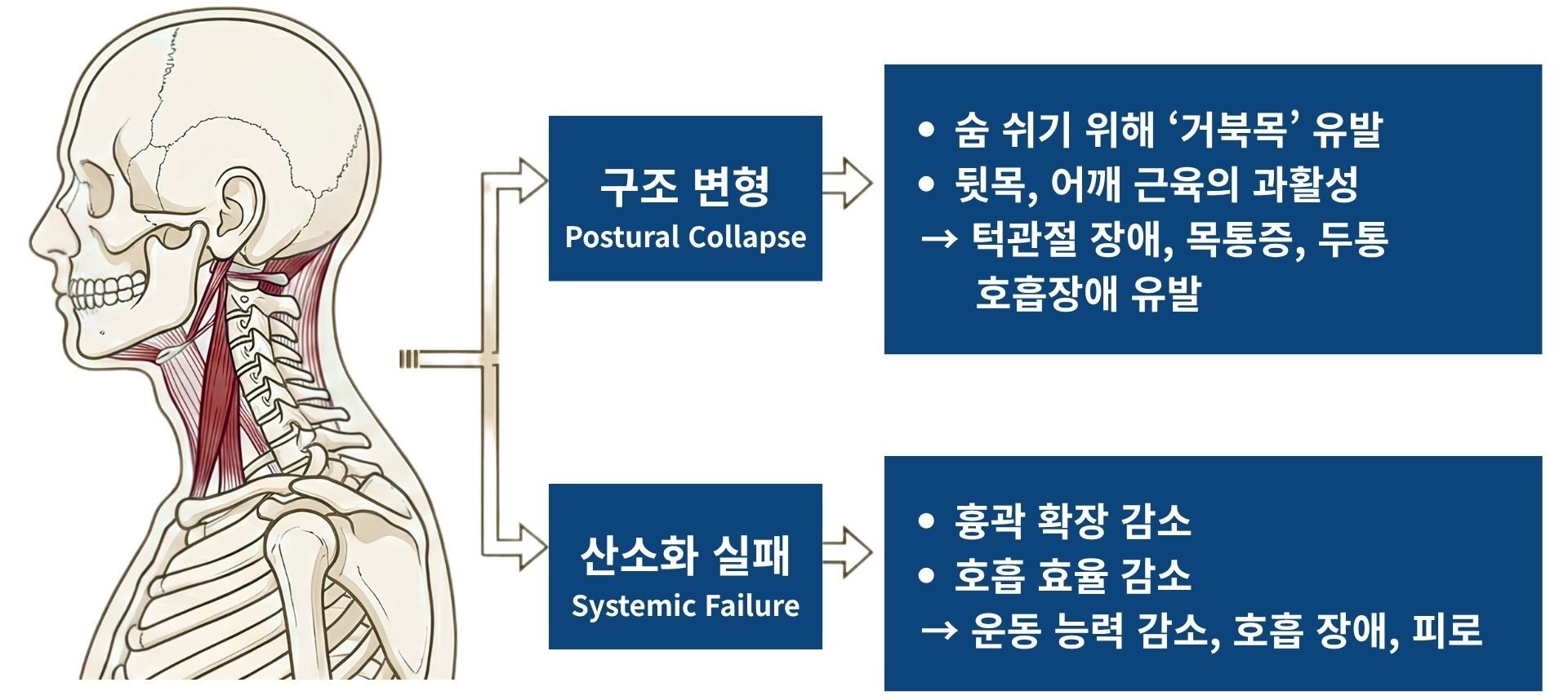 코막힘 → 구강호흡 → 혀 하강 → 상악궁 협착 → 치아·얼굴형 변화 → 턱관절·거북목으로 이어지는 연쇄 과정 도식