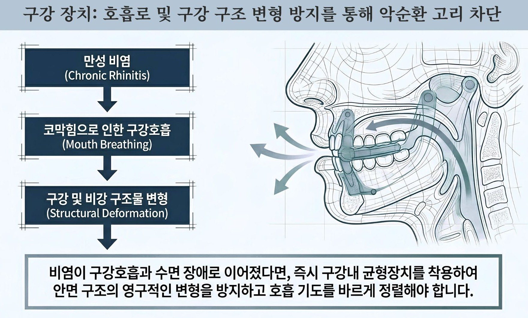 구강내 균형 장치(IBA)를 적용한 모습