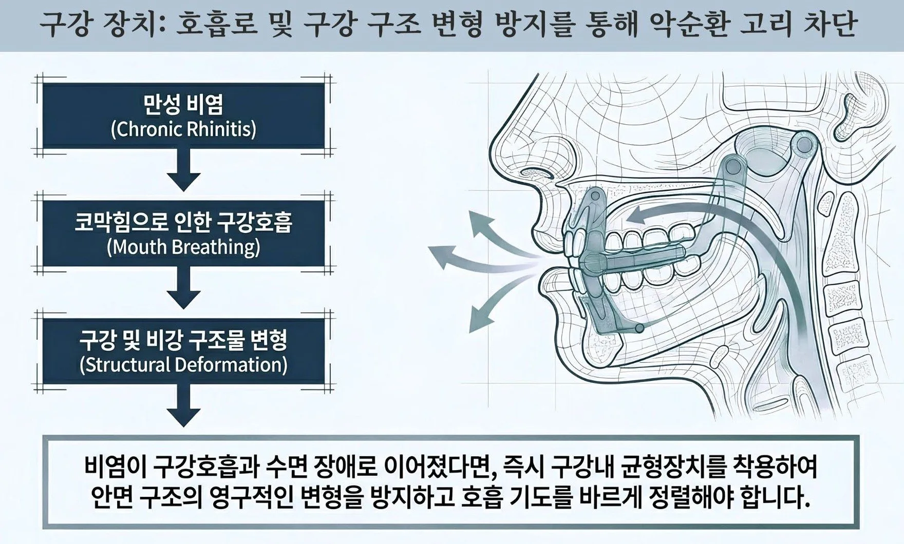 구강내 균형 장치(IBA)를 적용한 모습