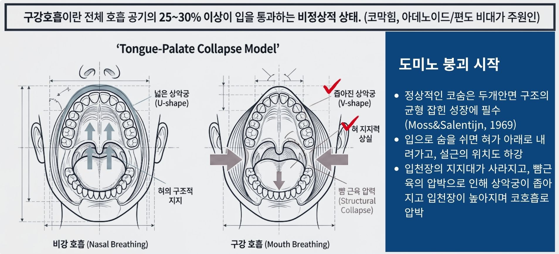 코막힘으로 인한 구강호흡과 혀 위치 하강이 상악궁·얼굴 구조에 미치는 영향 도식