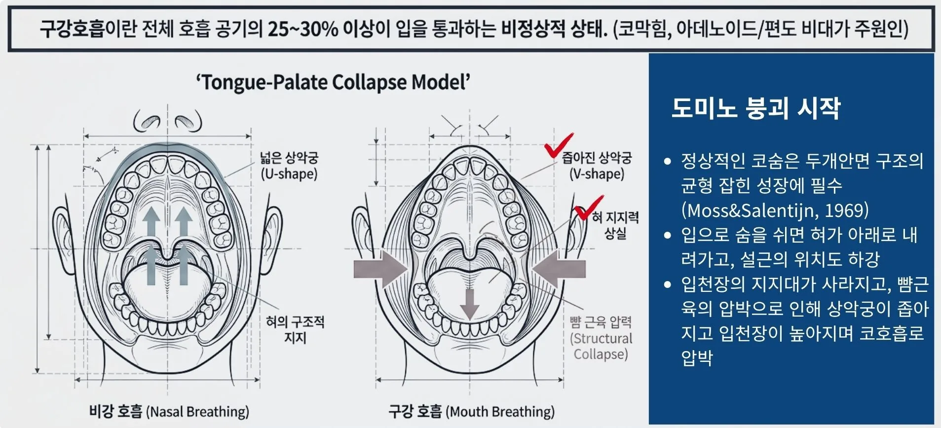 코막힘으로 인한 구강호흡과 혀 위치 하강이 상악궁·얼굴 구조에 미치는 영향 도식