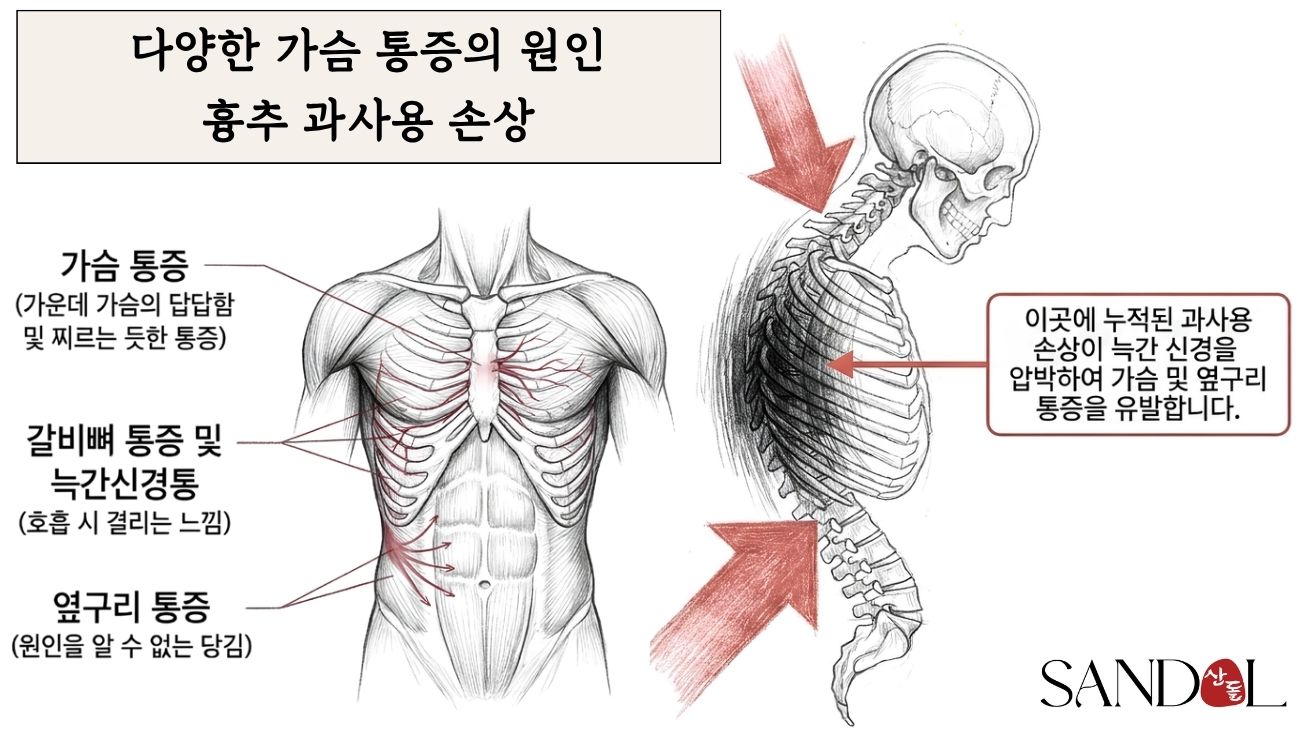가슴 부위 통증의 역학적 원인: 흉추 과사용 손상