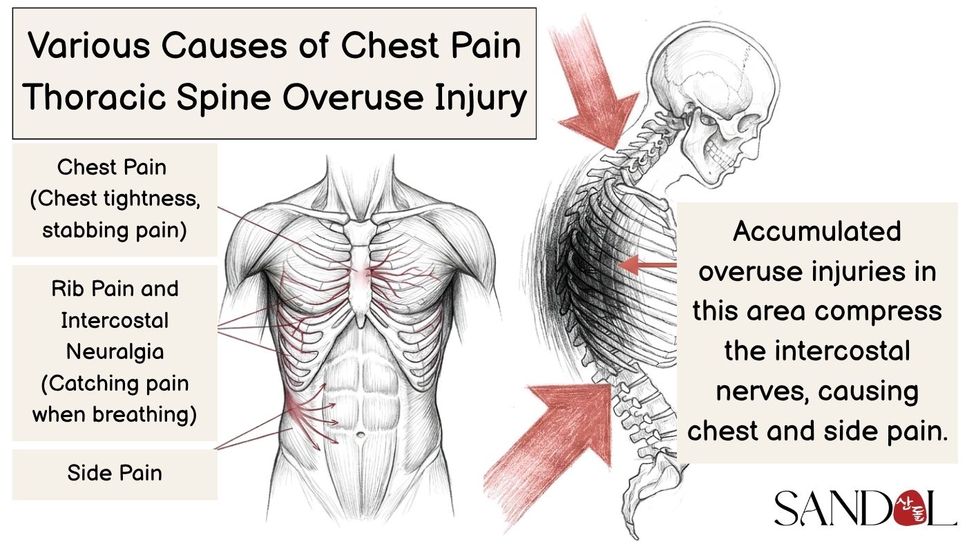 The mechanical cause of chest-area pain: thoracic overuse injury