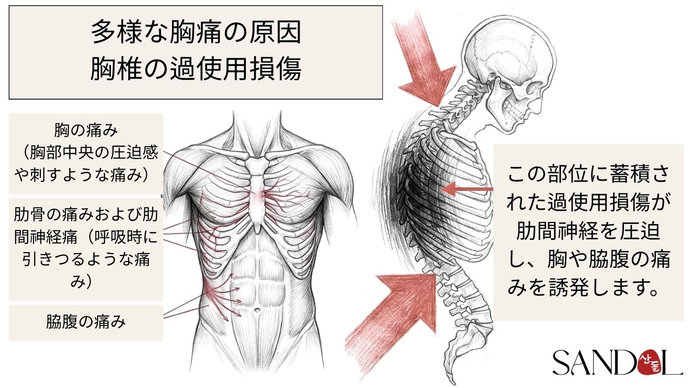胸部の痛みの機械的な原因：胸椎の使い過ぎによる損傷