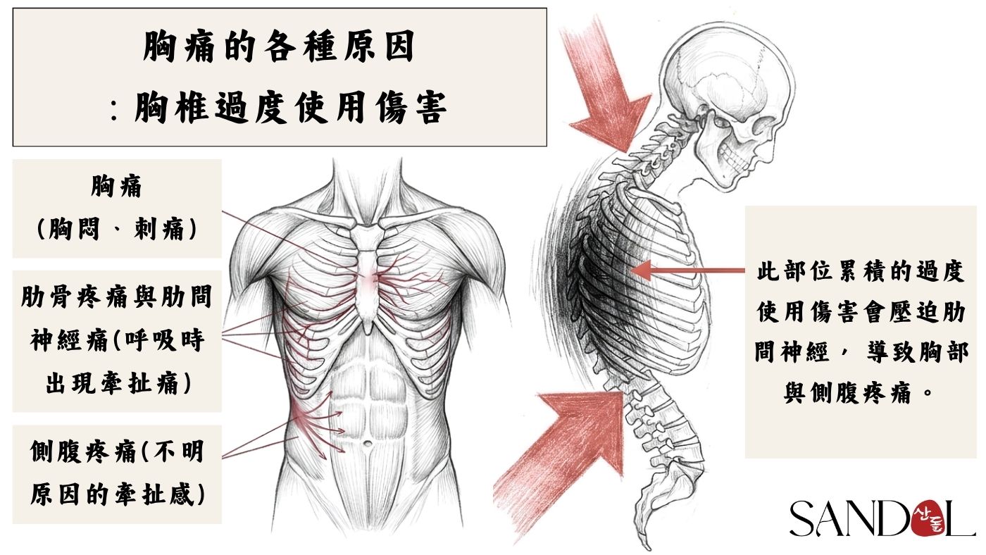 胸部部位疼痛的力學原因：胸椎過度使用損傷
