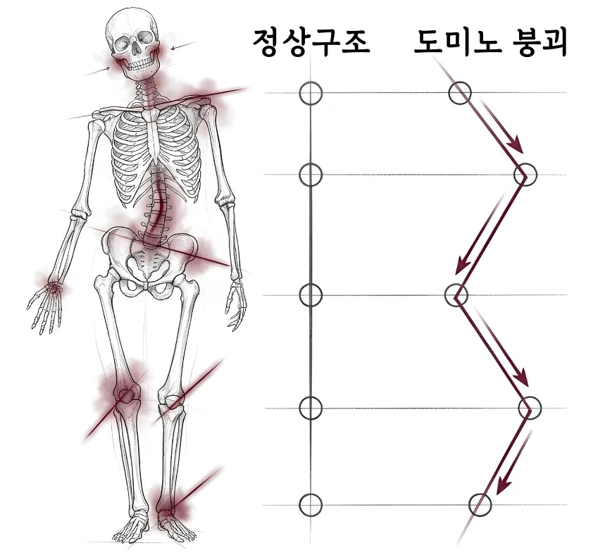 턱의 틀어짐이 목·어깨·등·허리·골반·무릎·발로 연쇄적으로 이어지는 모습