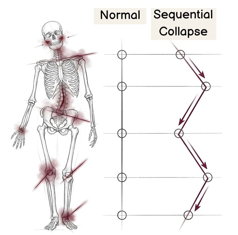 A jaw misalignment leading in a chain to the neck, shoulder, back, waist, pelvis, knee, and foot