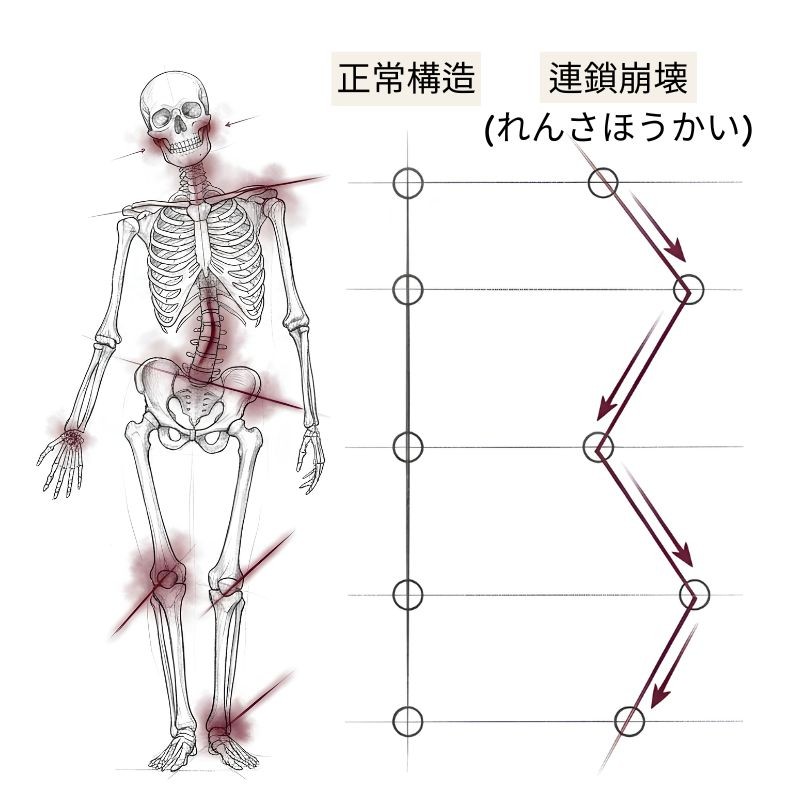 顎のずれが、首・肩・背中・腰・骨盤・膝・足へと連鎖していく様子