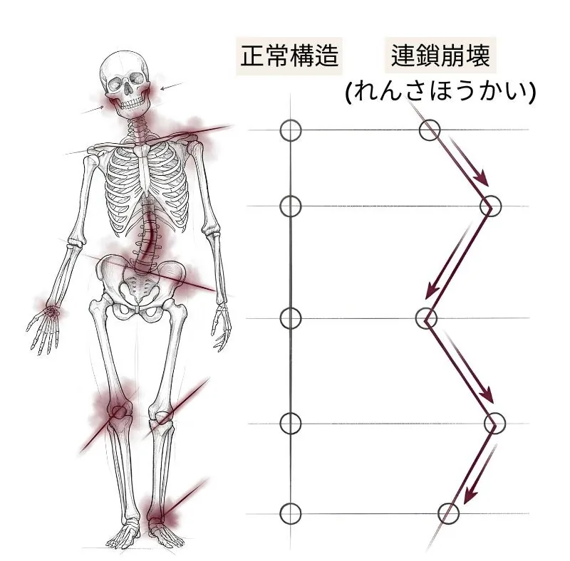 顎のずれが、首・肩・背中・腰・骨盤・膝・足へと連鎖していく様子