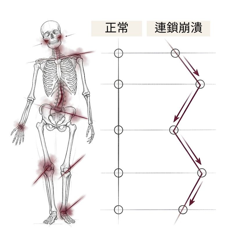 下顎的錯位連鎖延伸至頸·肩·背·腰·骨盆·膝·足的樣貌