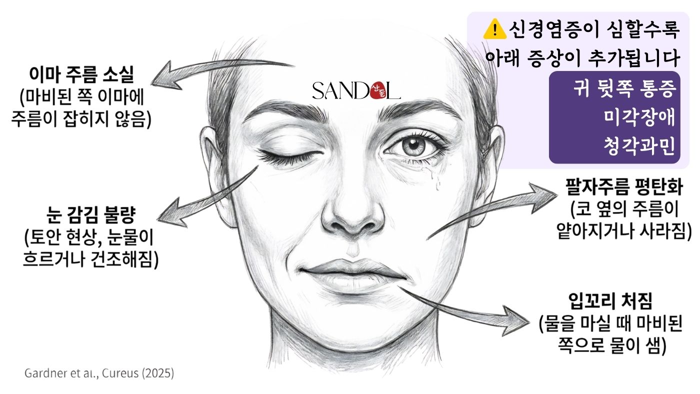 발병 초기 72시간의 안면마비 증상 지도 — 이마·눈, 귀 뒤, 입, 혀