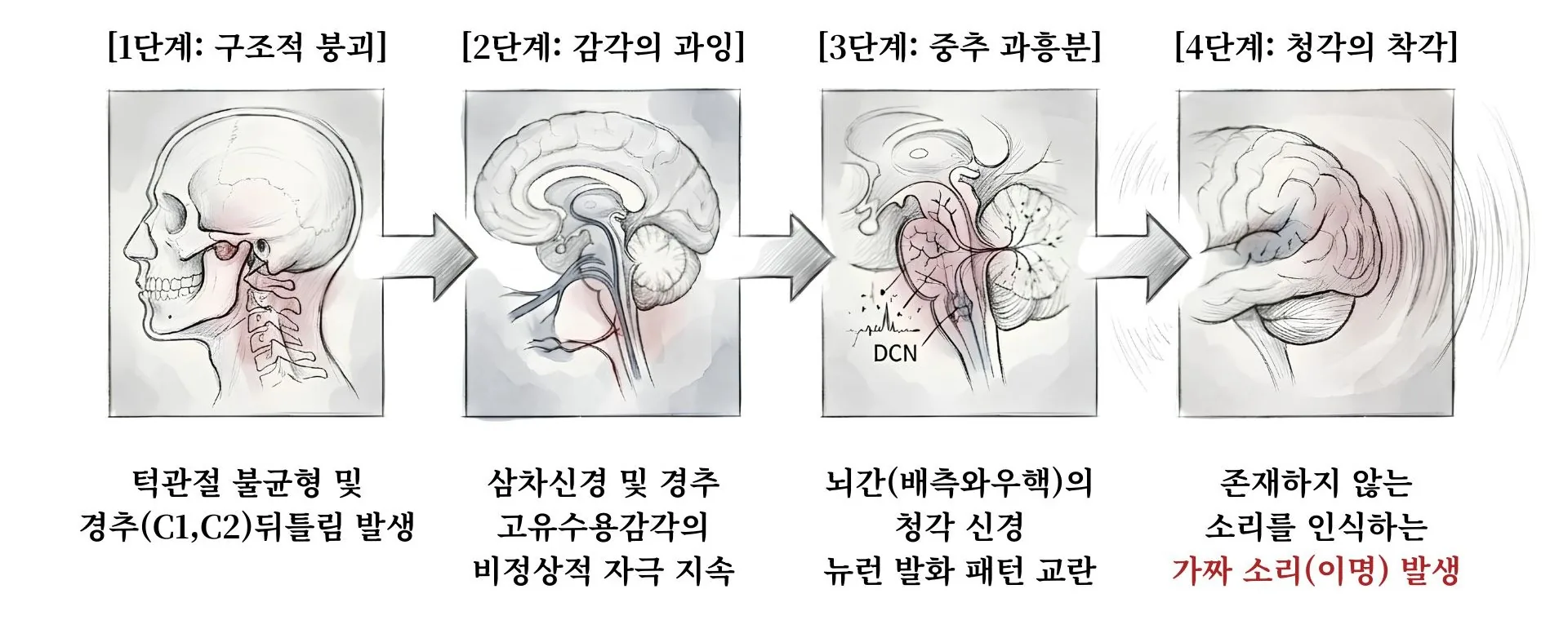 턱관절·경추 뒤틀림(구조적 붕괴) → 삼차신경·경추 고유수용감각의 비정상 자극(감각의 과잉) → 뇌간(배측와우핵) 청각 뉴런 발화 패턴 교란(중추 과흥분) → 존재하지 않는 소리를 인식하는 가짜 소리(청각의 착각)로 이어지는 4단계 과정 도식