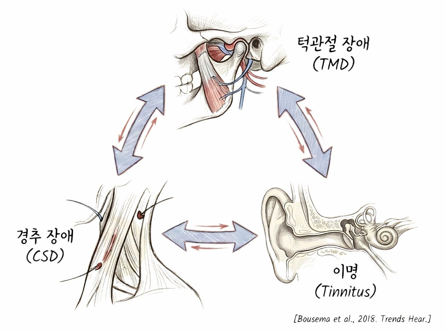 턱관절 장애(TMD)·경추 장애(CSD)·이명(Tinnitus)이 서로 양방향으로 영향을 주고받는 연결 관계 도식 (Bousema et al., 2018. Trends in Hearing)