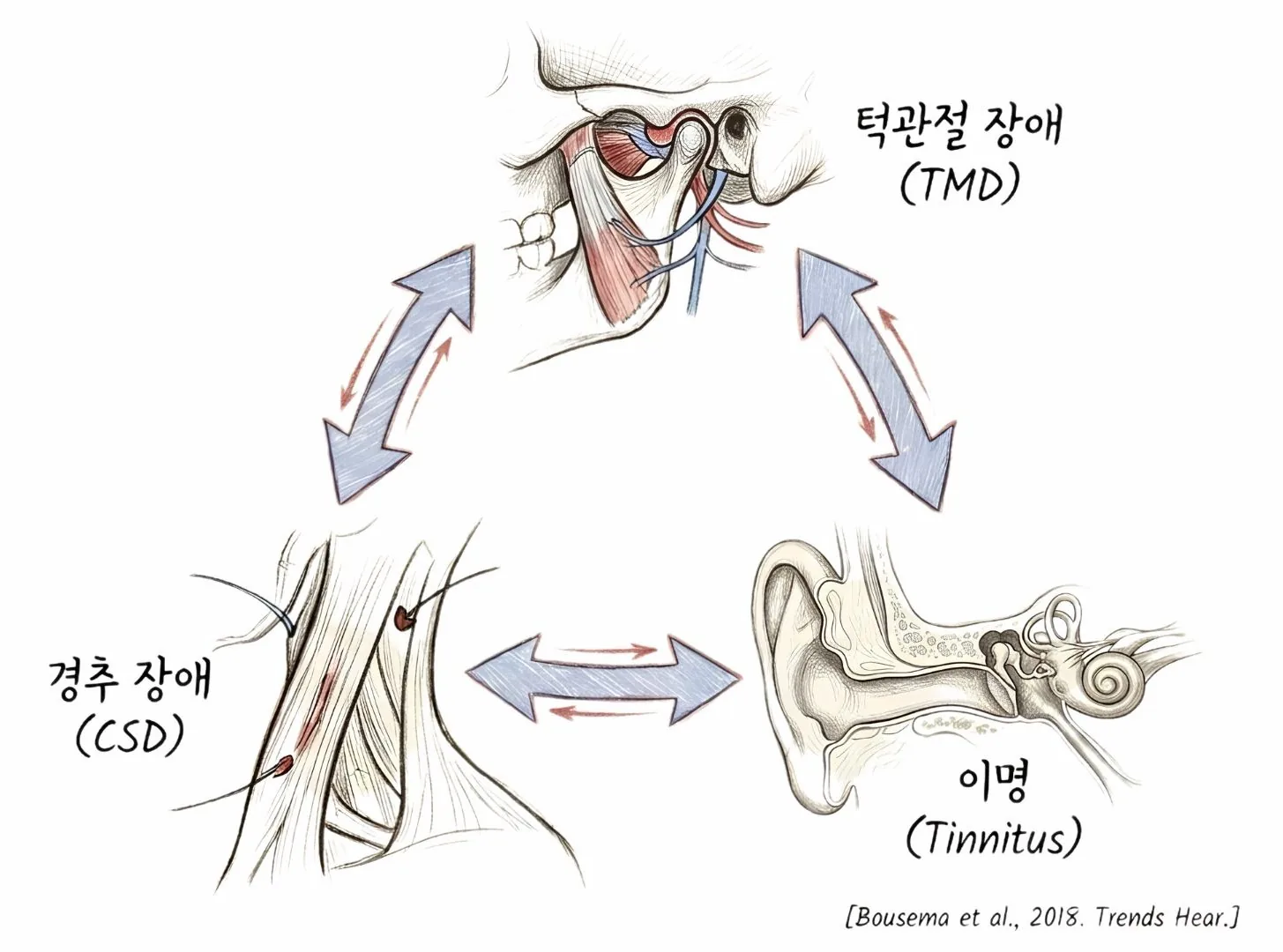 턱관절 장애(TMD)·경추 장애(CSD)·이명(Tinnitus)이 서로 양방향으로 영향을 주고받는 연결 관계 도식 (Bousema et al., 2018. Trends in Hearing)
